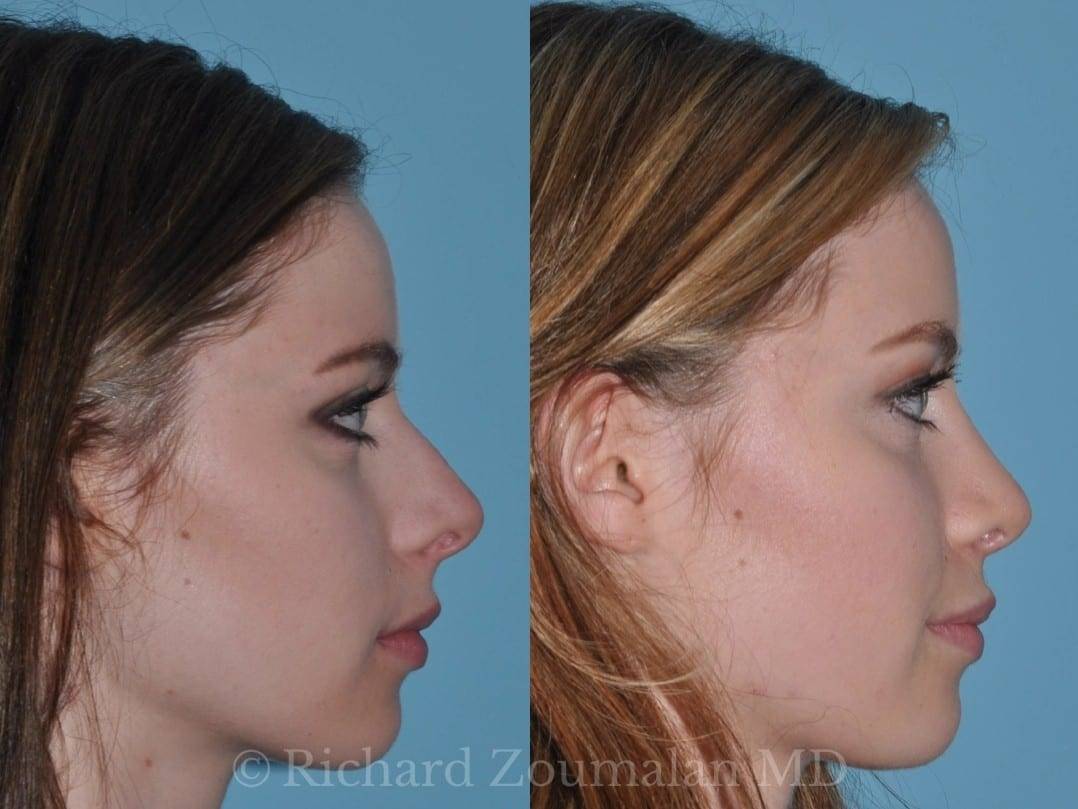 rhinoplasty-before-after-021.jpg